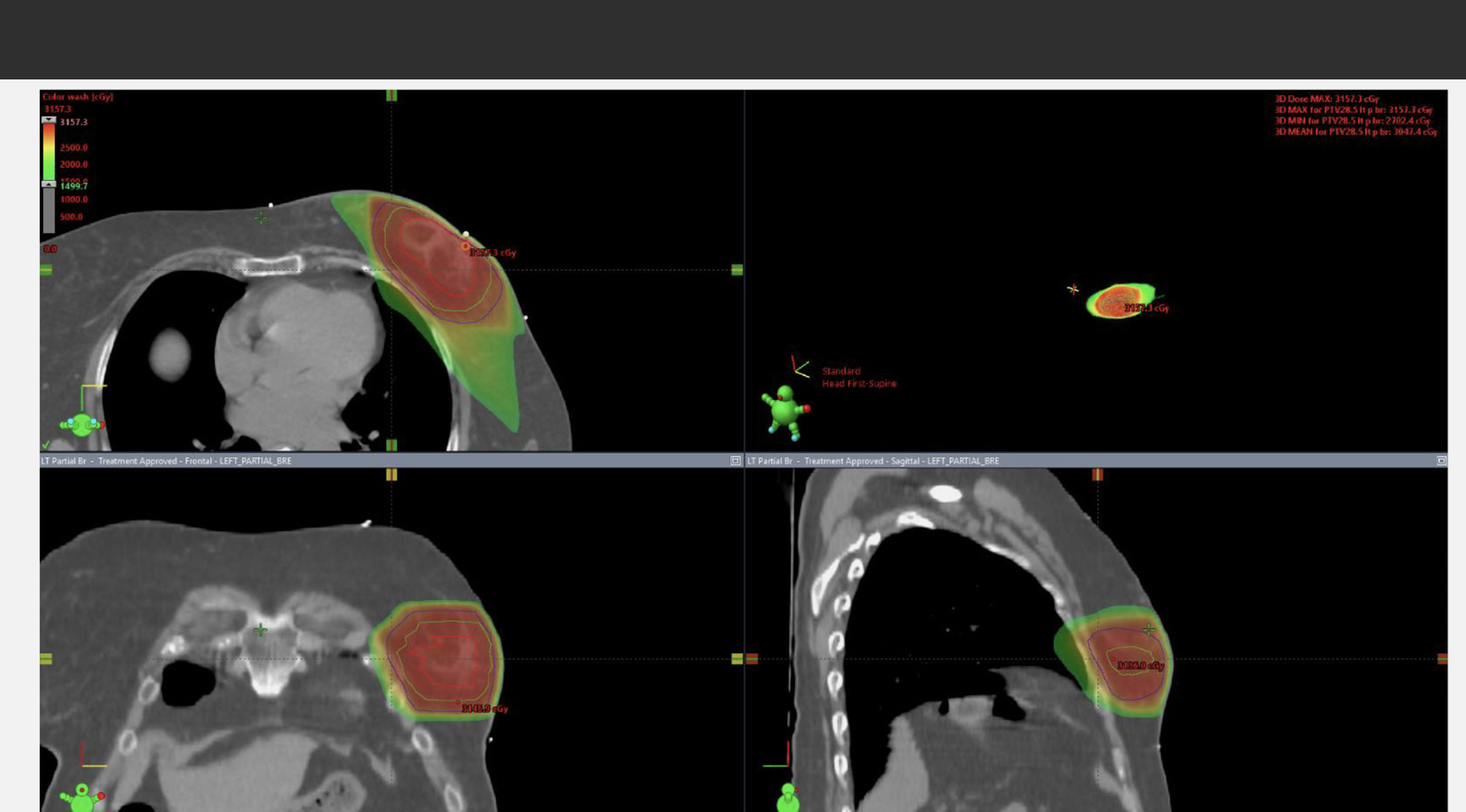Radiation dose distribution in a patient treated with lumpectomy with oncoplastic reconstruction