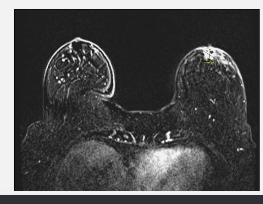 Bilateral breast MRI with contrast demonstrating subareolar enhancing mass
