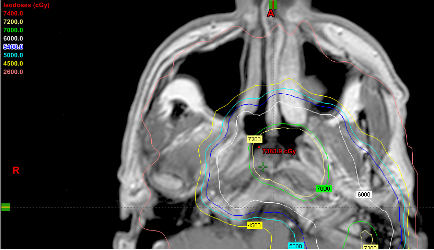 Head and neck MRI showing IMRT isodose distributions