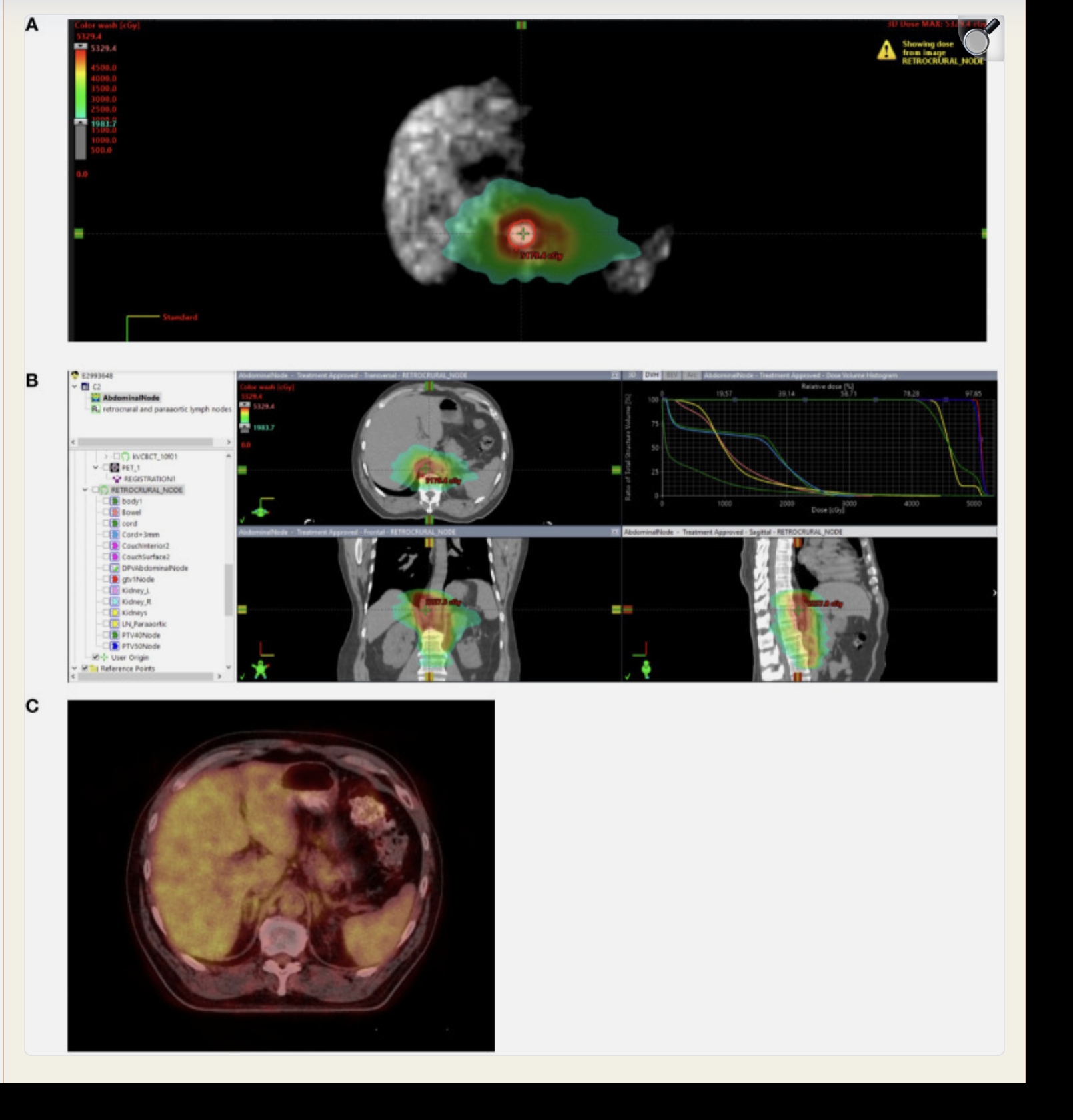 PET/CT images showing treatment planning and scale of response in metastatic rectal cancer