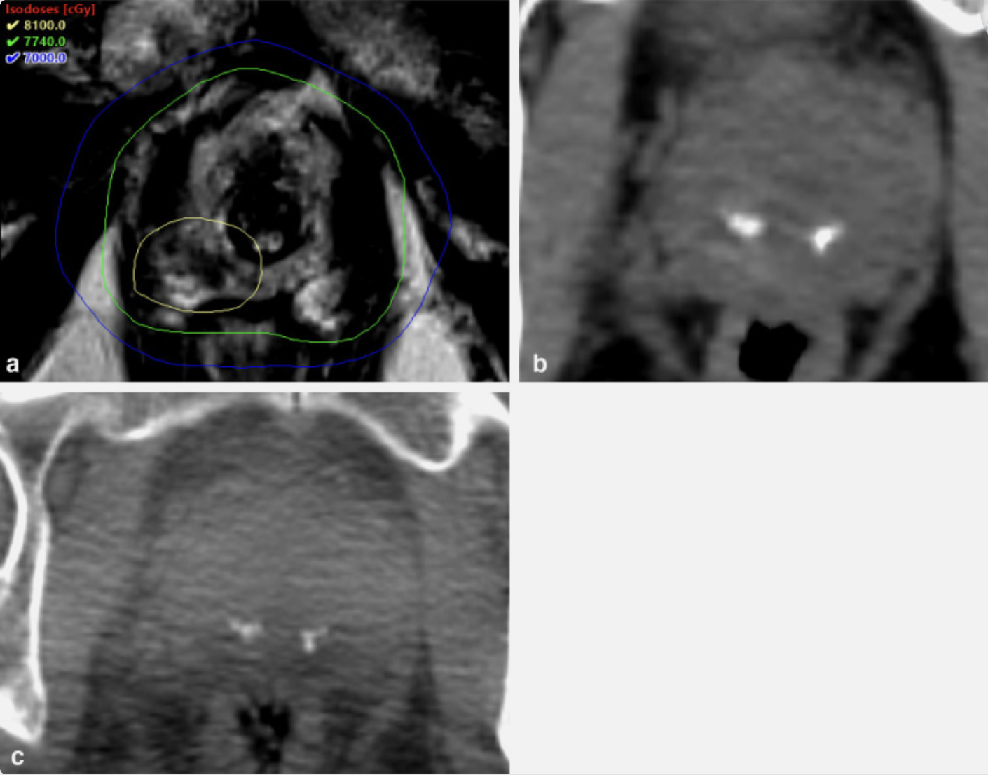 T2 MRI, CT simulation, and Cone Beam CT showing prostatic calculi used for image guidance